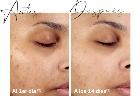 disminuye las manchas